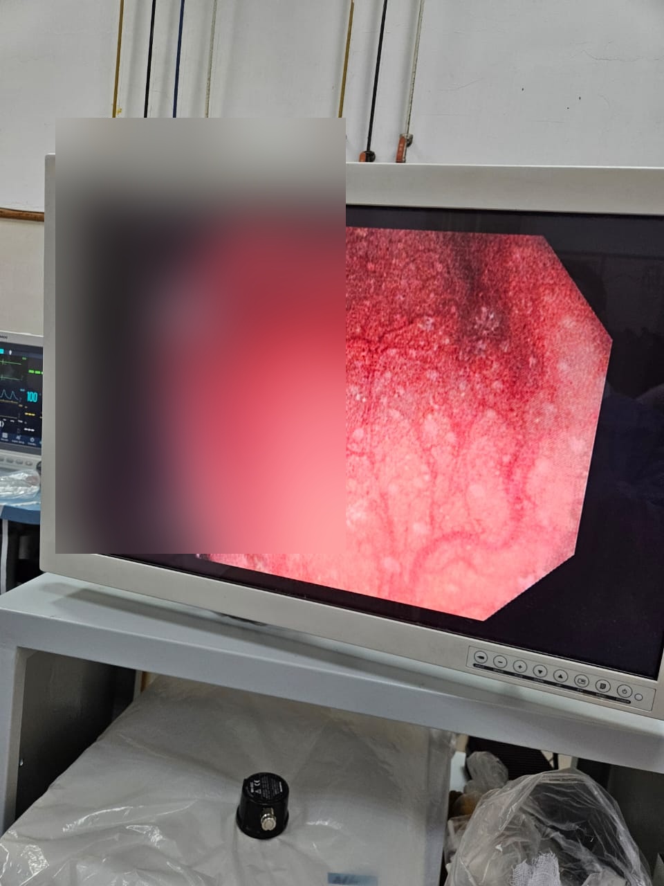 Colonic Lymphoid Aggregates On Nbi