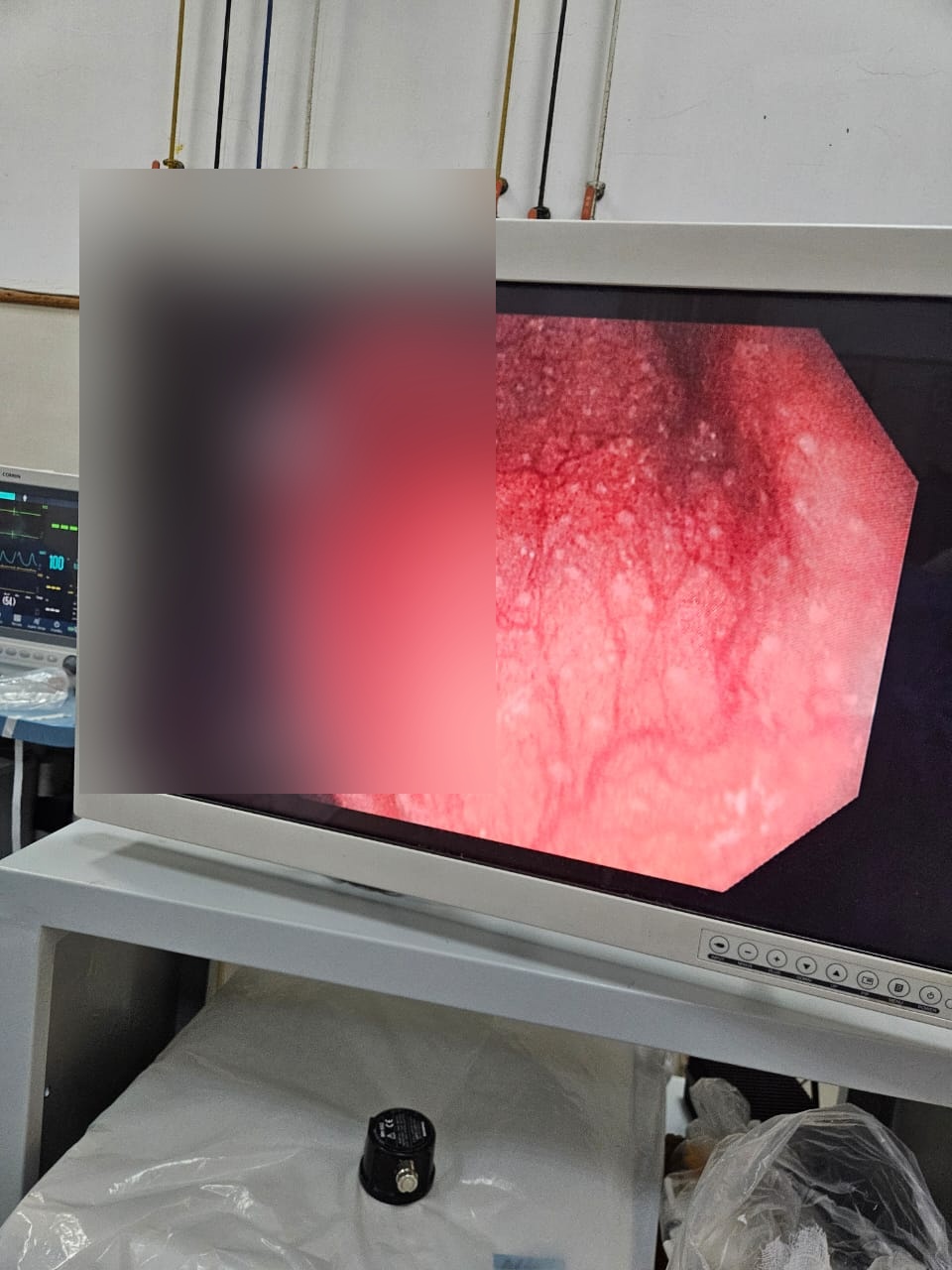 Lymphoid Hyperplasia In The Colon