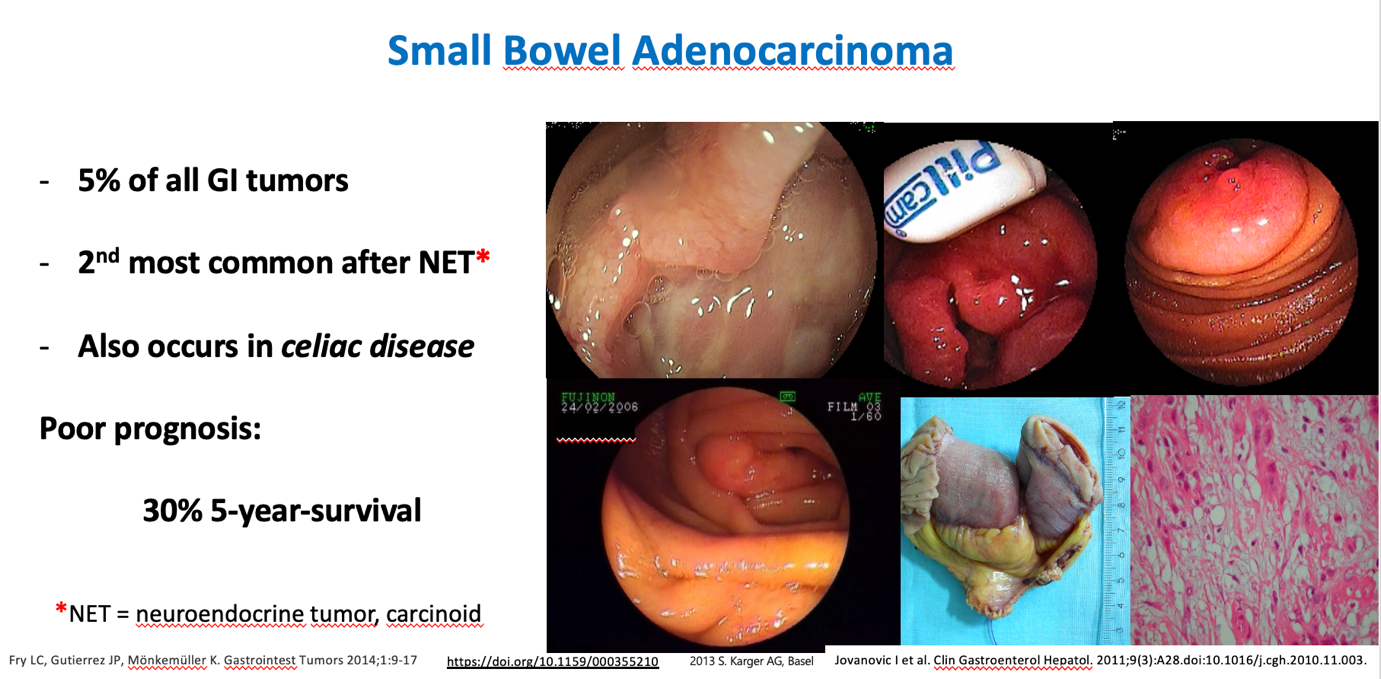 Teaching Slide Showing Small Bowel Adenocarcinoma In The Setting Of Celiac Disease With Endoscopic, Gross Pathology, And Histology Panels.