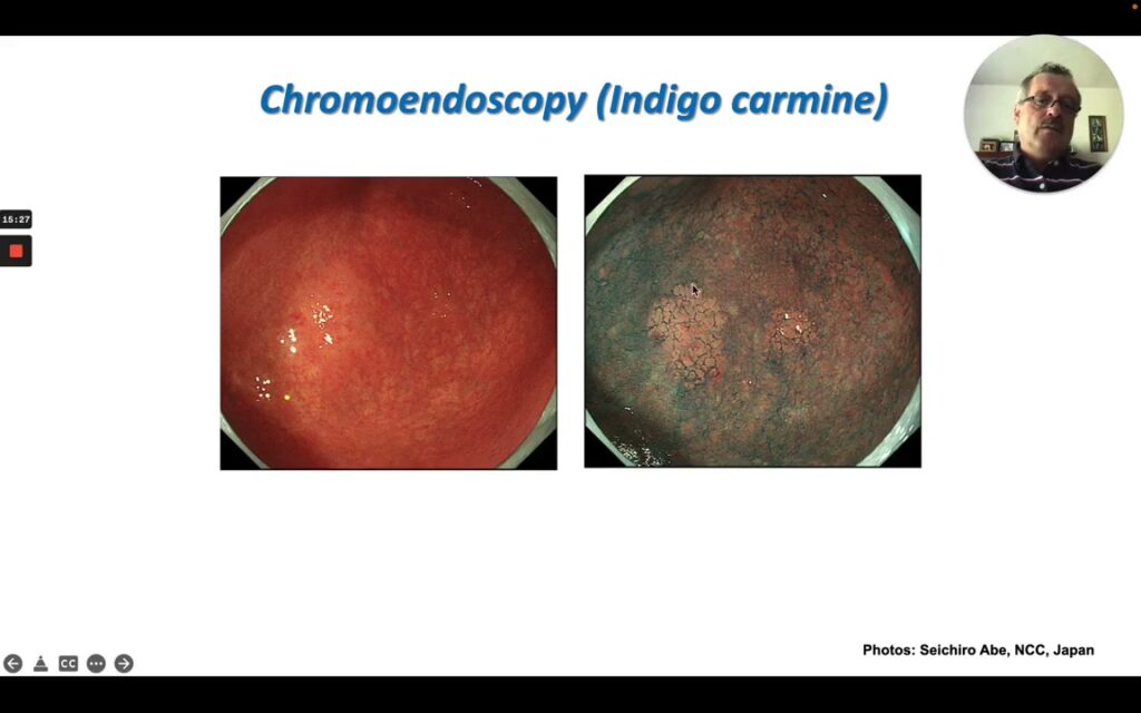 Chromoendoscopy With Indigo Carmine Revealing Early Gastric Cancer Mucosal Surface Irregularity