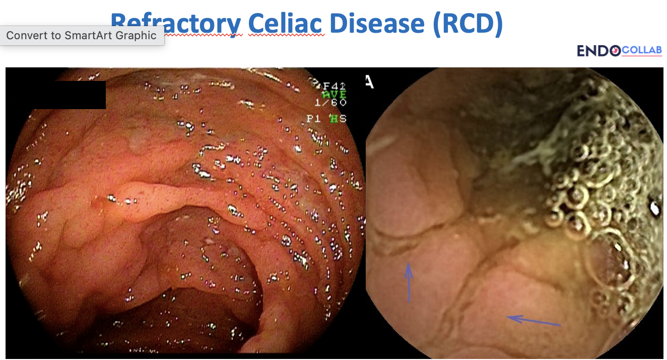 Gi Endoscopy Community &Amp; Education - Endocollab