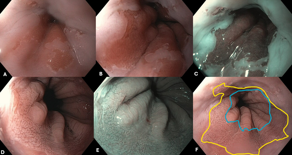 Acetic Acid Chromoendoscopy In Barrett Esophagus For Dysplasia Detection