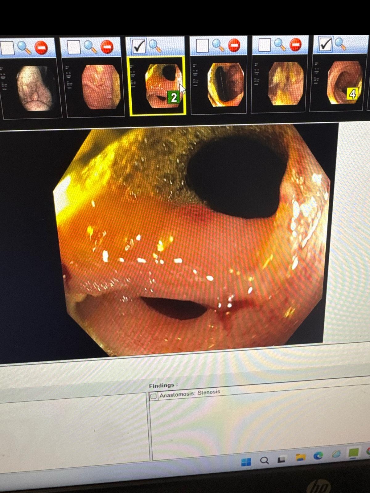 Septated Anastomotic Stricture In A Crohn&Amp;Apos;S Disease Patient