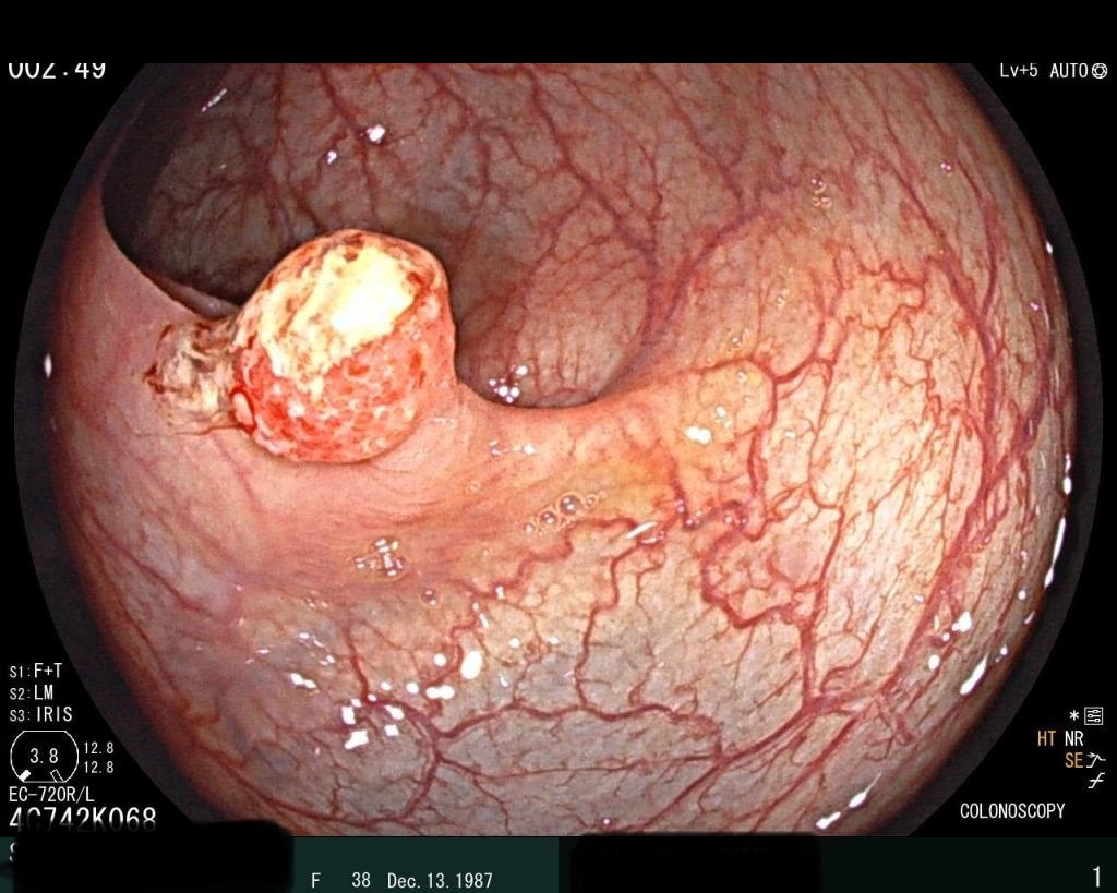 Gi Endoscopy Community &Amp; Education - Endocollab