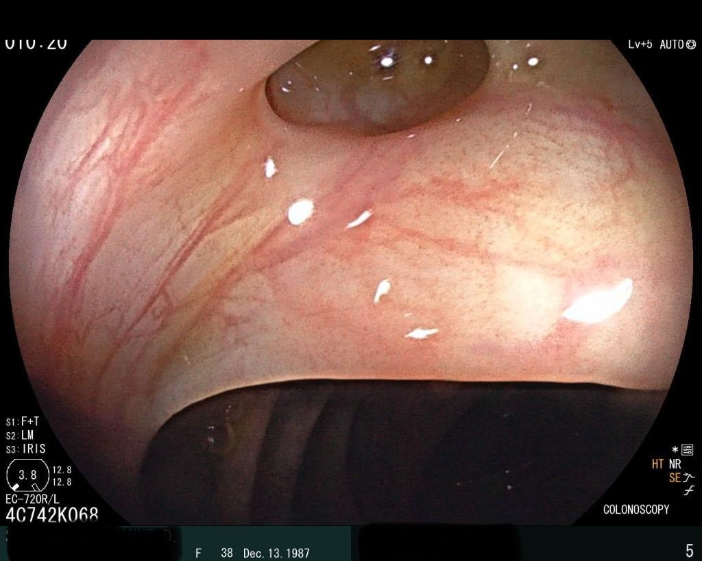 Close-Up View Of The Transverse Colon Protrusion