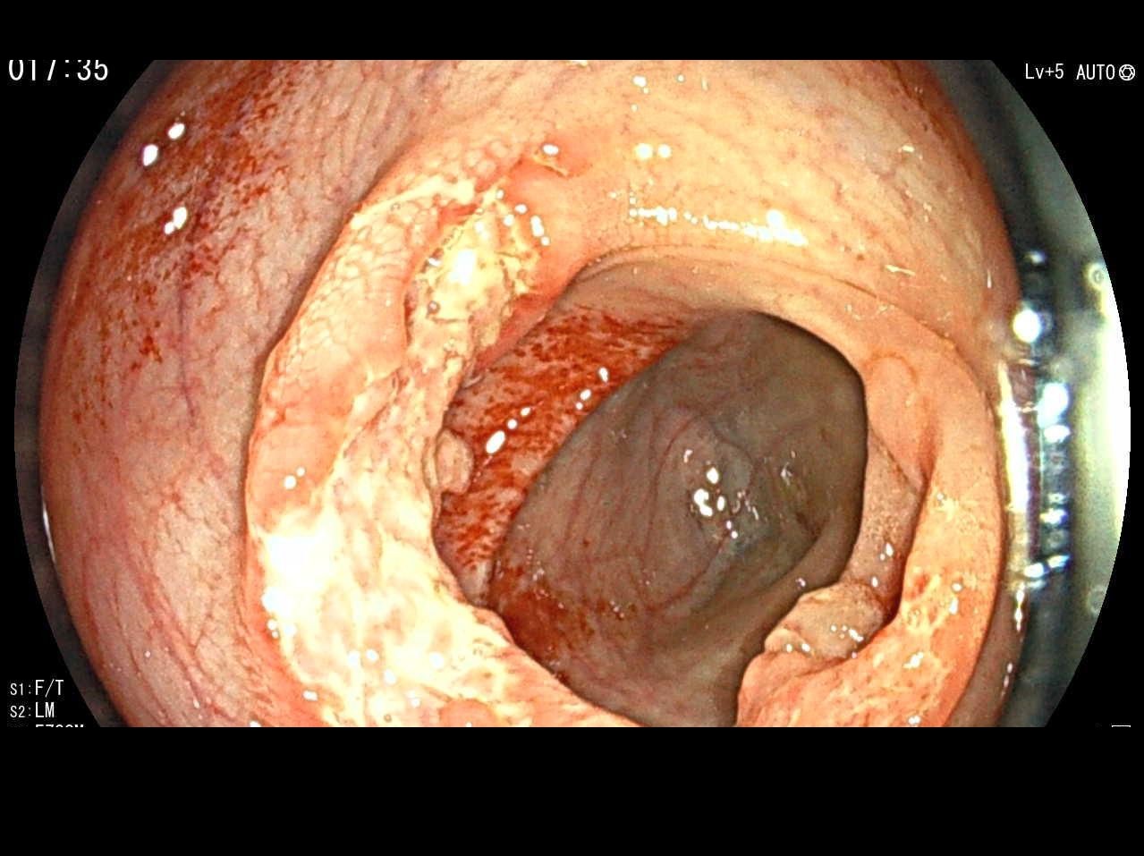 Colonoscopy Showing A Large Transverse Ulcer At The Ileocecal Valve With Surrounding Inflammation