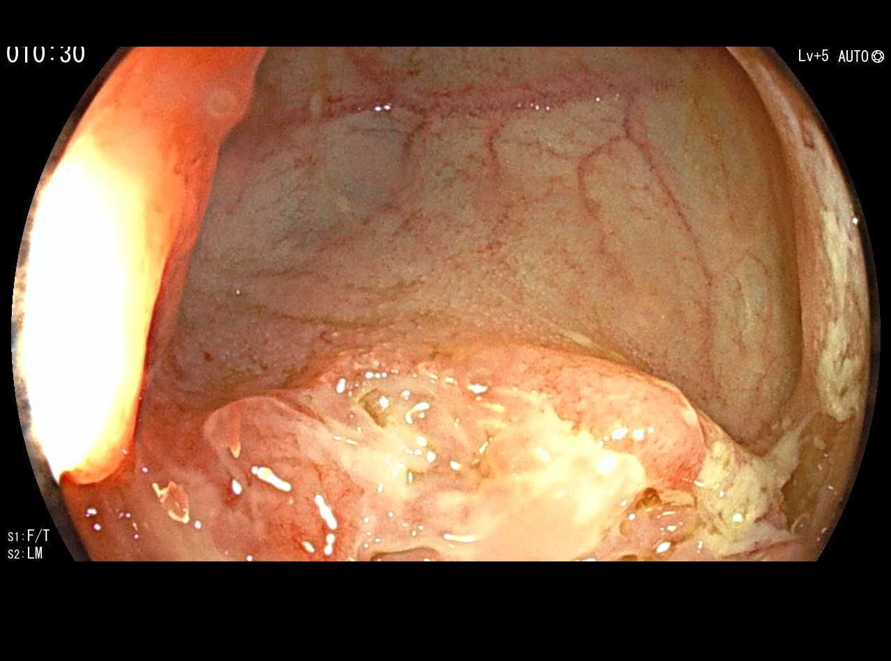 Deep Ulceration In The Terminal Ileum With Fibrinous Exudate
