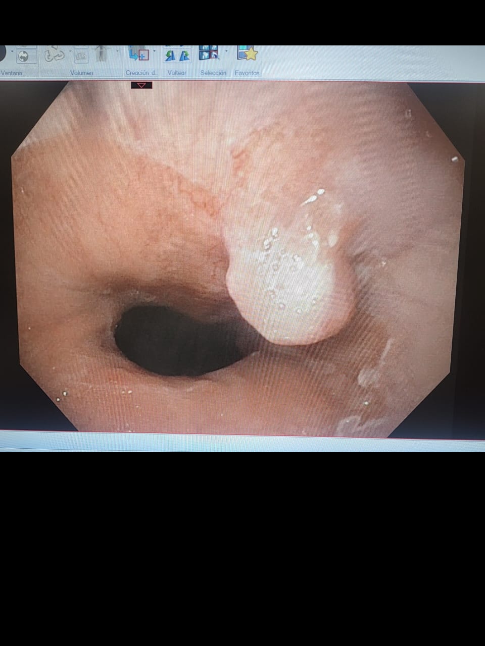 Endoscopic View Of A Nodular Lesion At The Gastroesophageal Junction
