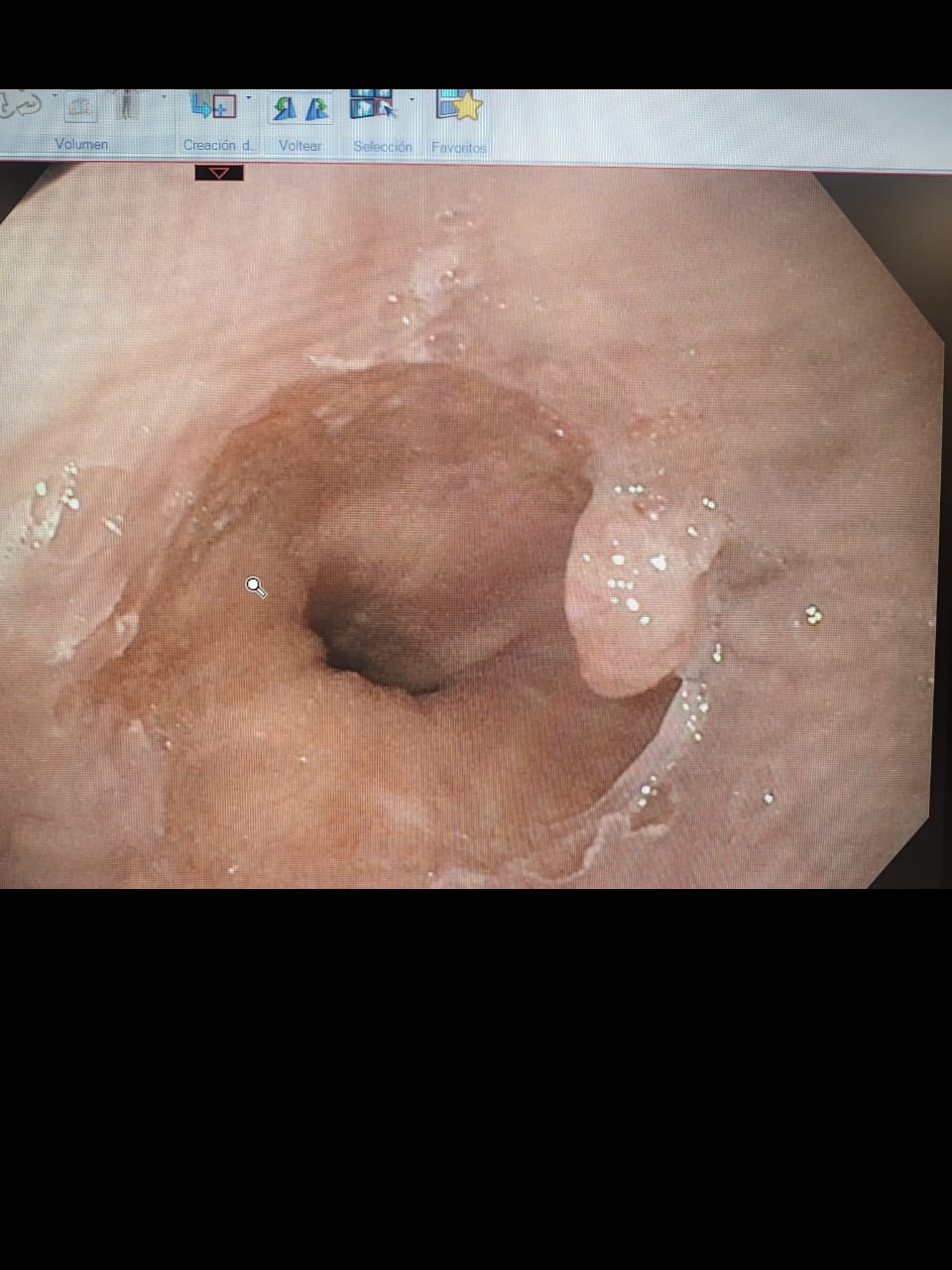 Close-Up Of The Gej Nodular Lesion Under White-Light Endoscopy