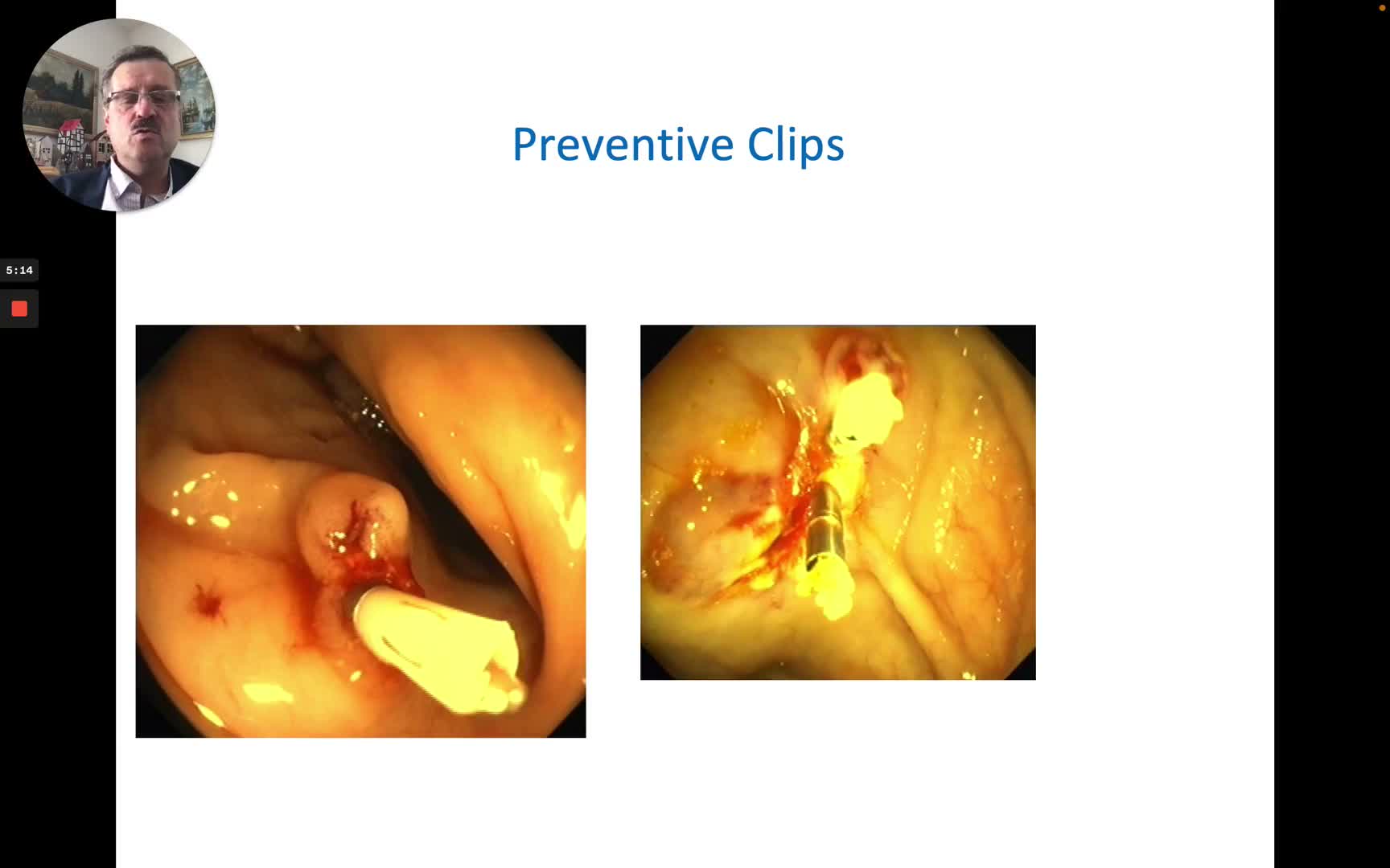 Prophylactic Clip Placement After Polypectomy