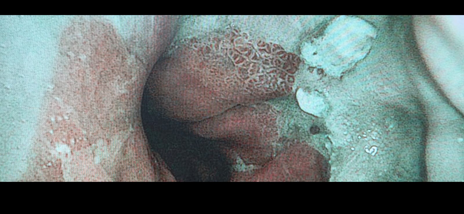 Lesion At The Esophagogastric Junction With Surrounding Erosive Changes