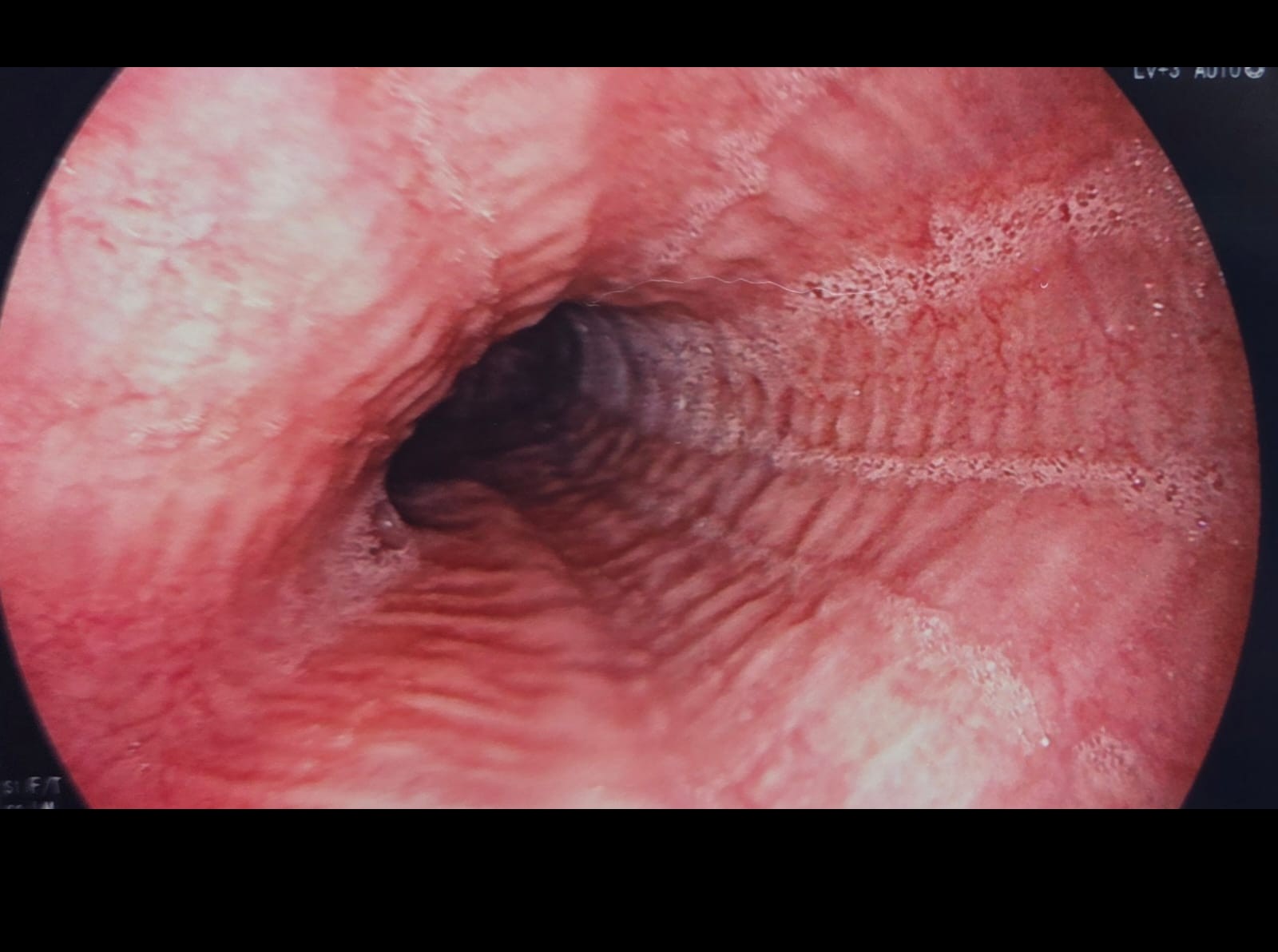 Esophageal Trachealization Consistent With Eosinophilic Esophagitis