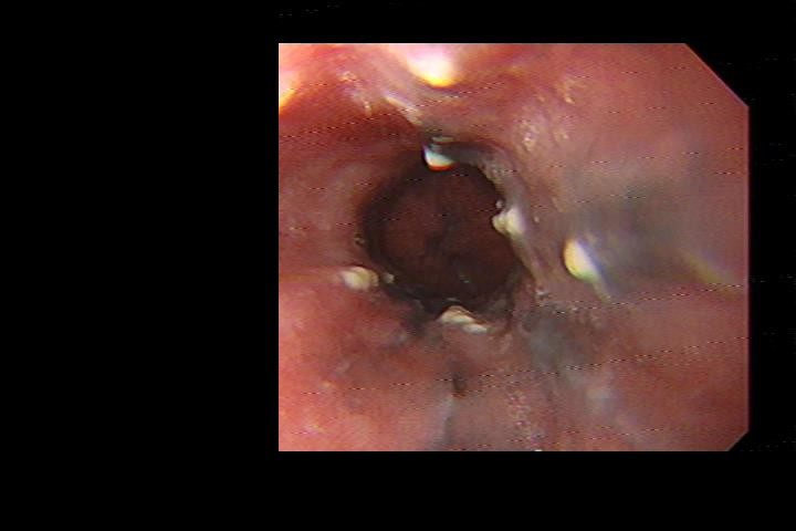 Black Discoloration Of The Distal Esophageal Mucosa