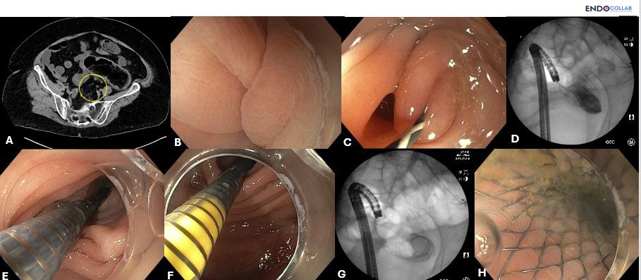 Endoscopic Placement of a Self-Expanding Metal Stent for Obstructing Sigmoid Diverticulitis