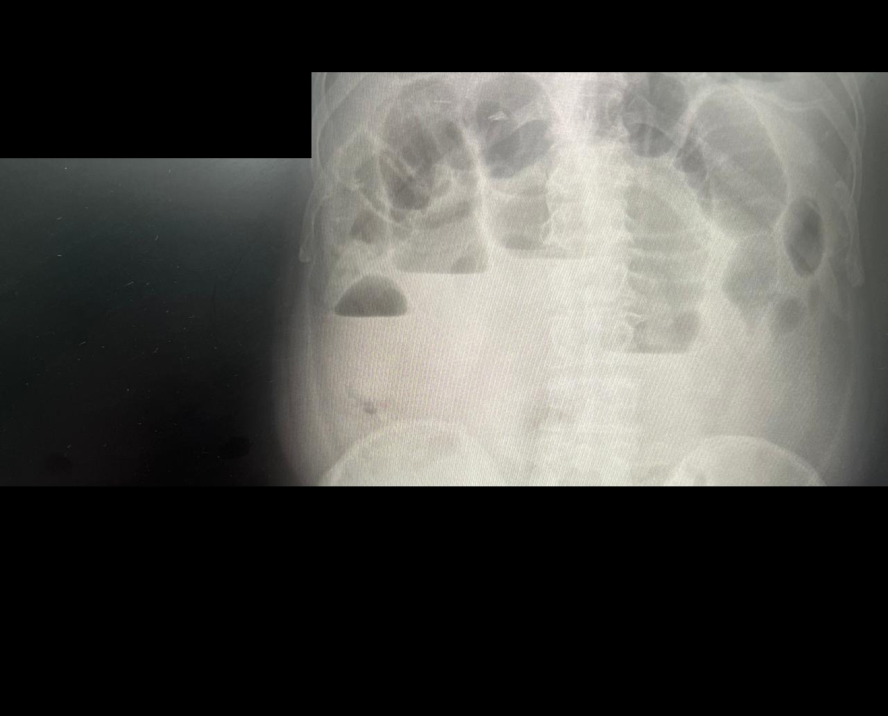 Endocollab Community Digest - Issue 8: June 8 - July 17, 2026 1 Erect Abdominal Radiograph Showing Dilated Small-Bowel Loops With Multiple Air-Fluid Levels