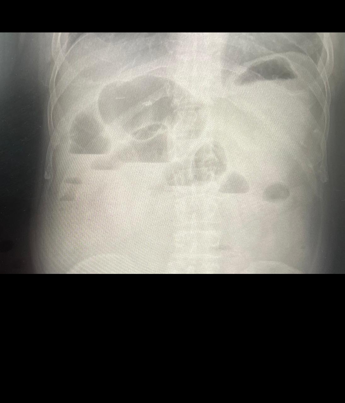 Endocollab Community Digest - Issue 8: June 8 - July 17, 2026 2 Follow-Up Erect Abdominal Radiograph With Persistent Air-Fluid Levels