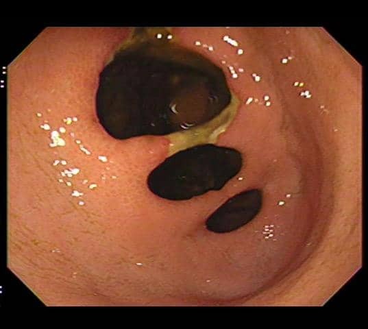 Endocollab Community Digest - Issue 8: June 8 - July 17, 2026 3 Endoscopic View Of Multiple Openings In The Antro-Pyloric Region