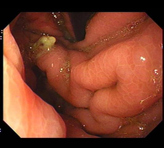 Endocollab Community Digest - Issue 8: June 8 - July 17, 2026 4 Ulcerated Antro-Pyloric Mucosa With Fistulous Openings