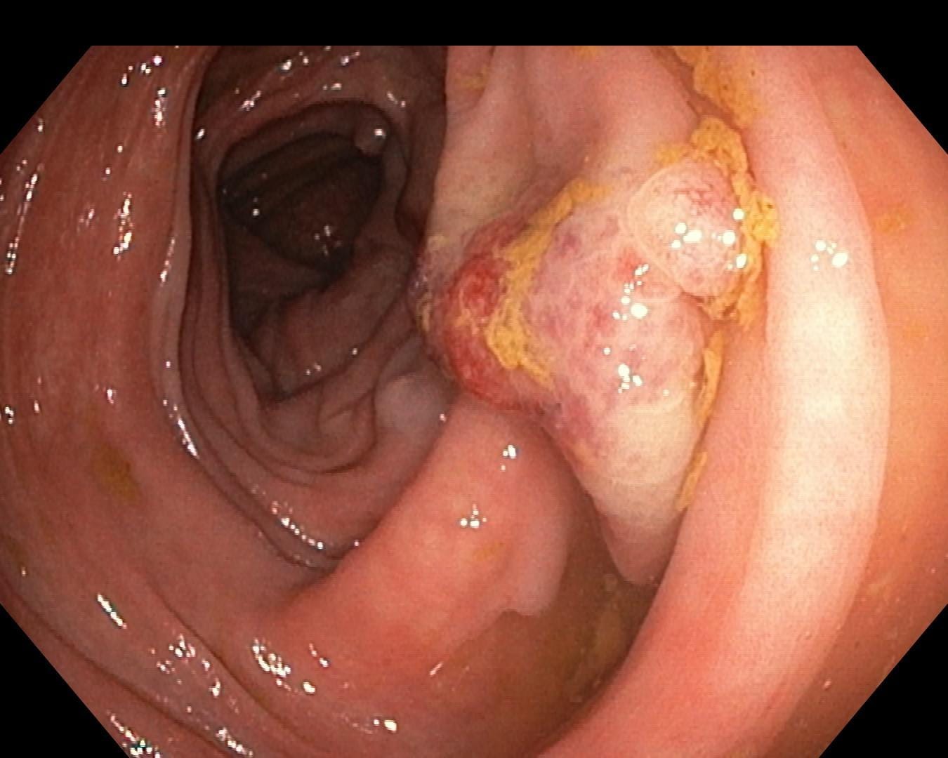 Gi Endoscopy Community &Amp; Education - Endocollab