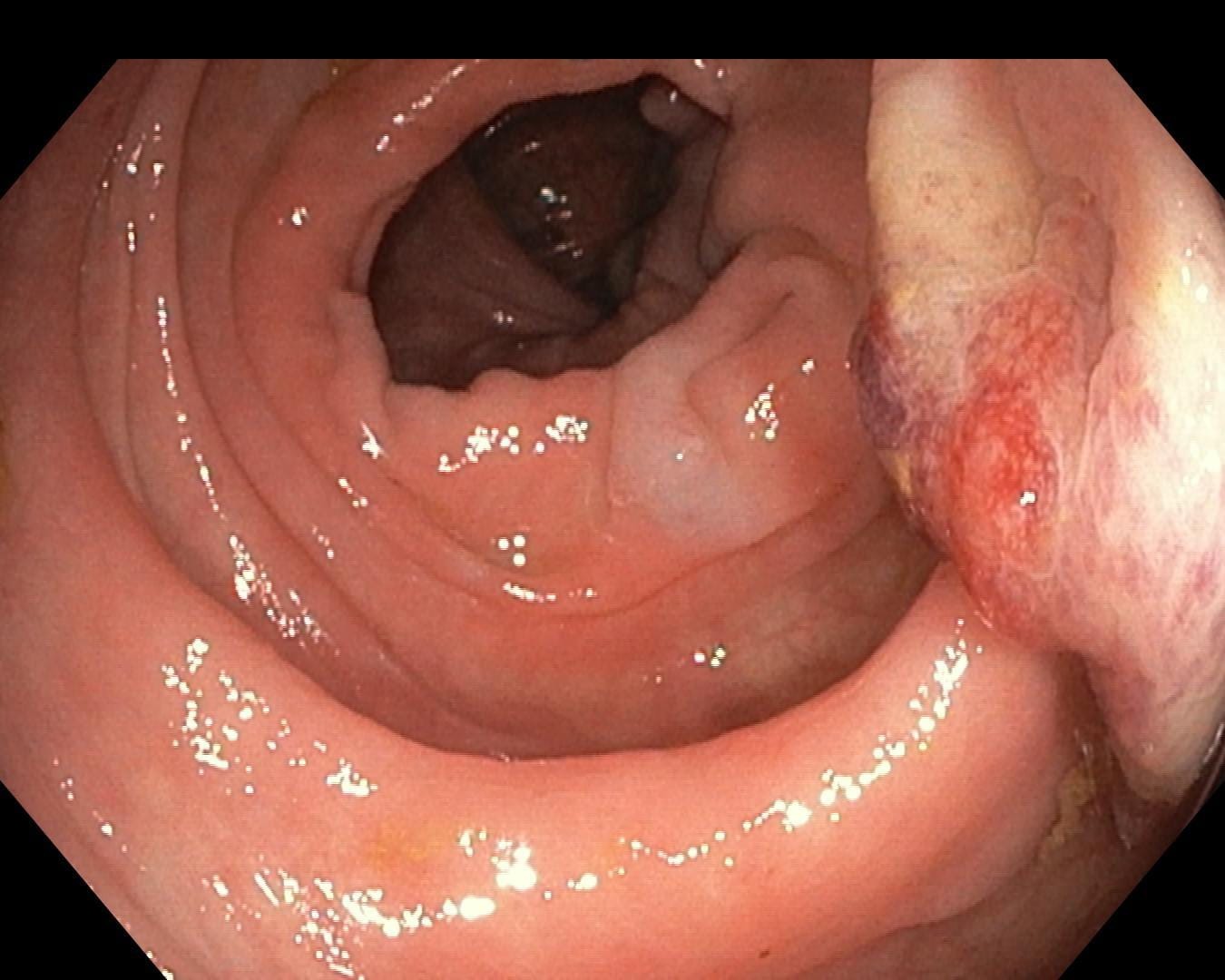 Endocollab Community Digest - Issue 8: June 8 - July 17, 2026 6 Alternate View Of The Descending-Colon Mass With Friable Surface