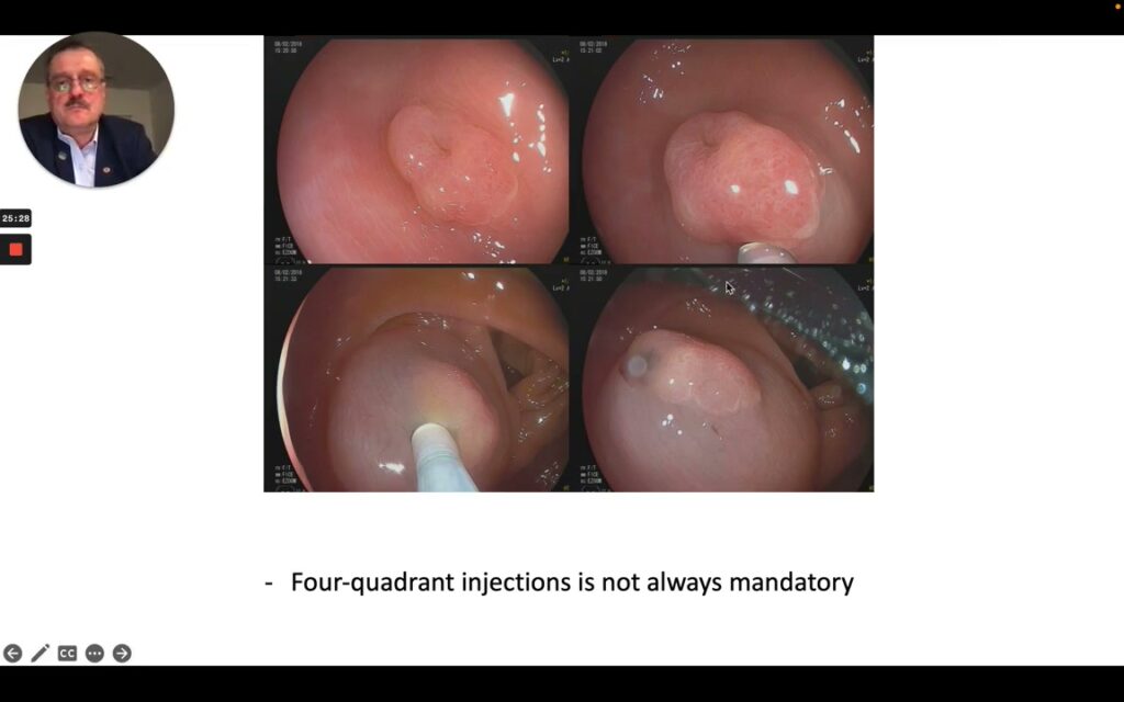 Submucosal Injection Reshaping A 6 To 10 Mm Colon Polyp Before Snare Resection