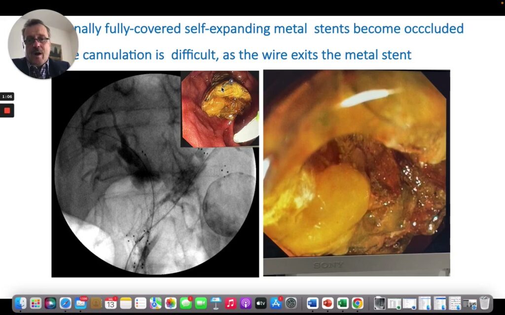 Occluded Self-Expanding Metal Stent With Difficult Wire Cannulation During Ercp