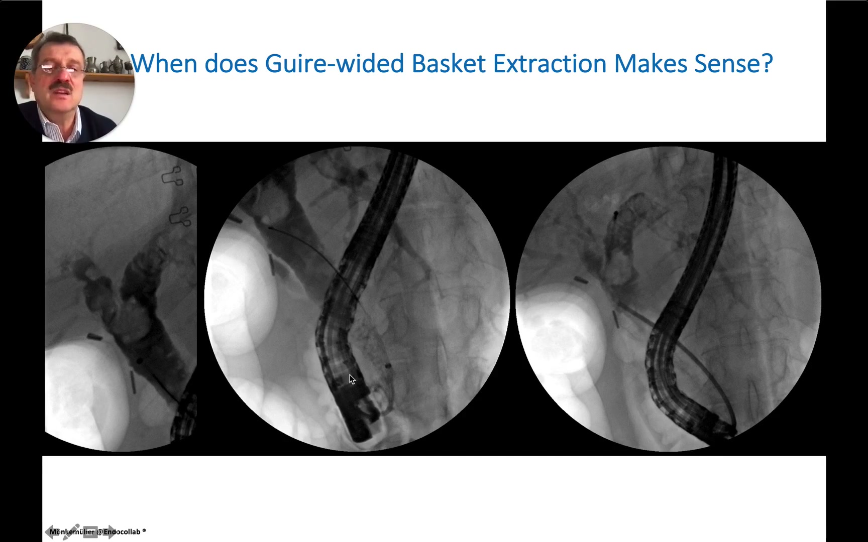Fluoroscopy Examples Of When Guidewire-Aided Basket Extraction Makes Sense