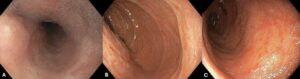 Esophageal Intramural Pseudodiverticulosis (Eip)