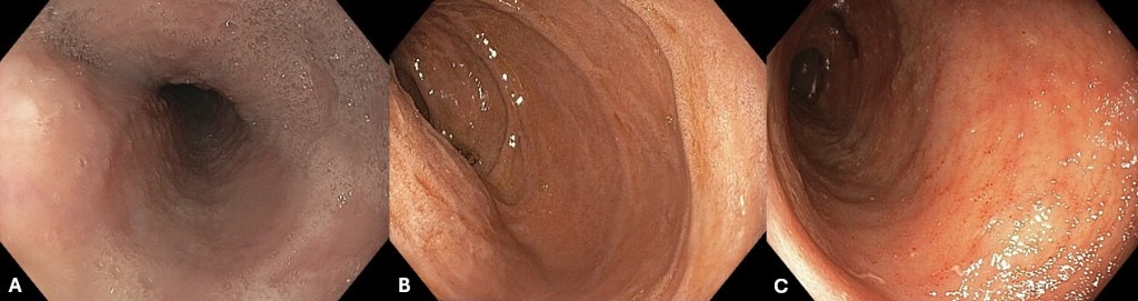 Gi Endoscopy Community &Amp; Education - Endocollab