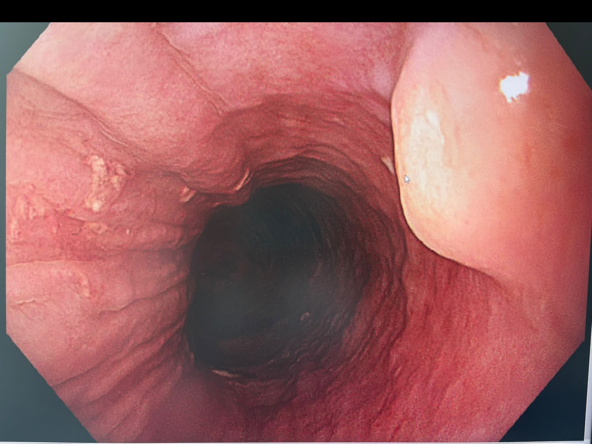 Endocollab Community Digest - Issue 8: June 8 - July 17, 2026 9 Small Pale Esophageal Subepithelial Lesion Consistent With Leiomyoma