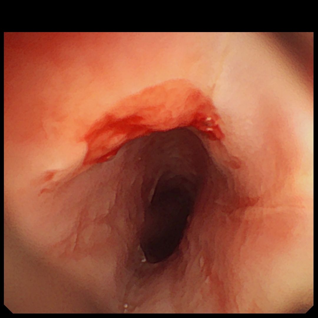 Endocollab Community Digest - Issue 8: June 8 - July 17, 2026 7 Salmon-Colored Inlet Patch In The Proximal Esophagus On White Light