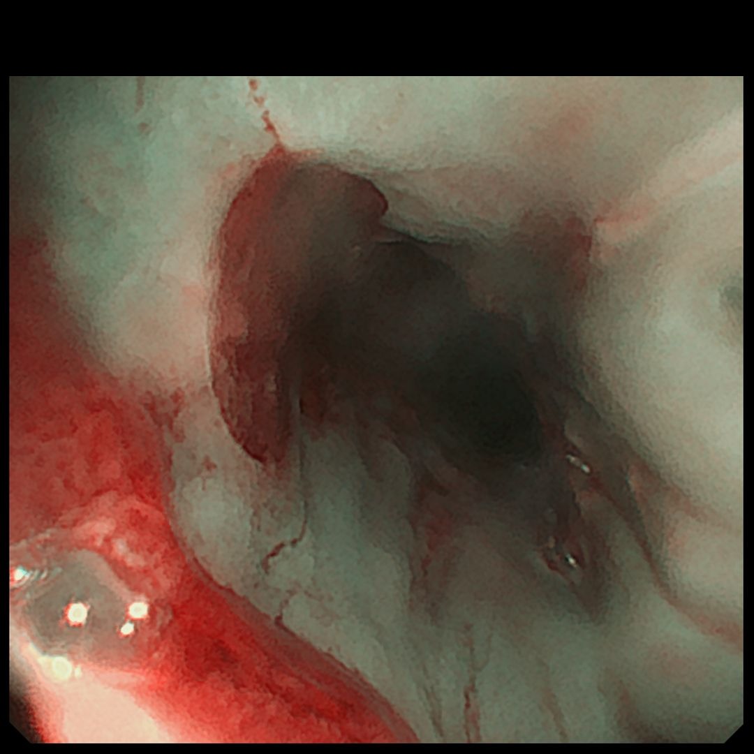 Endocollab Community Digest - Issue 8: June 8 - July 17, 2026 8 Alternate View Of The Cervical Esophageal Inlet Patch
