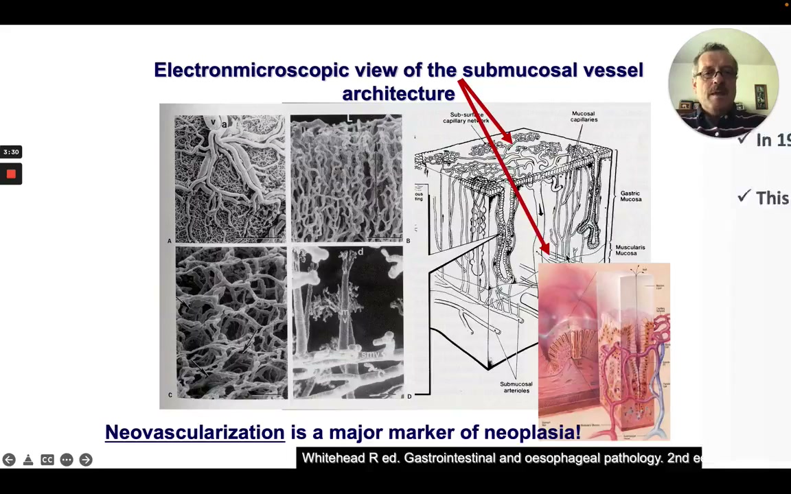 Electron Microscopic View Of Submucosal Vessel Architecture; Neovascularization As A Marker Of Neoplasia