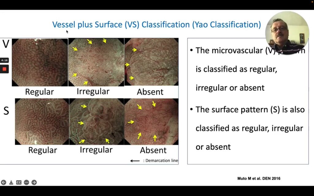 Yao Vessel-Plus-Surface Vs Classification Grid: Regular, Irregular, Or Absent
