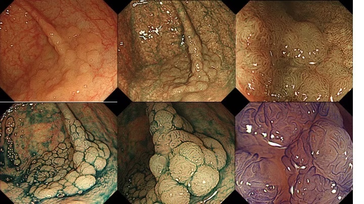 A Systematic Approach To Evaluate Laterally-Spreading Tumors (Lst) 1 A Systematic Approach To Evaluate Laterally-Spreading Tumors (Lst)