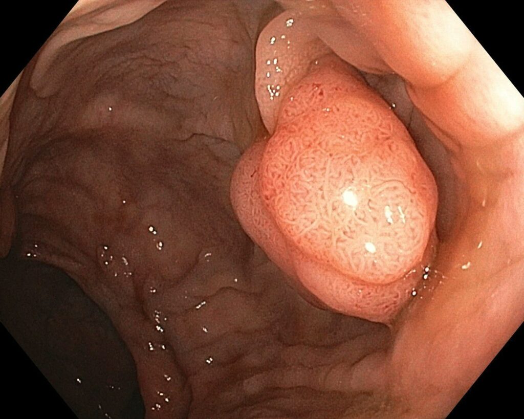 A Type 0-Ip Polyp – Classifying It Further With Kudo, Sano, Nice And Jnet