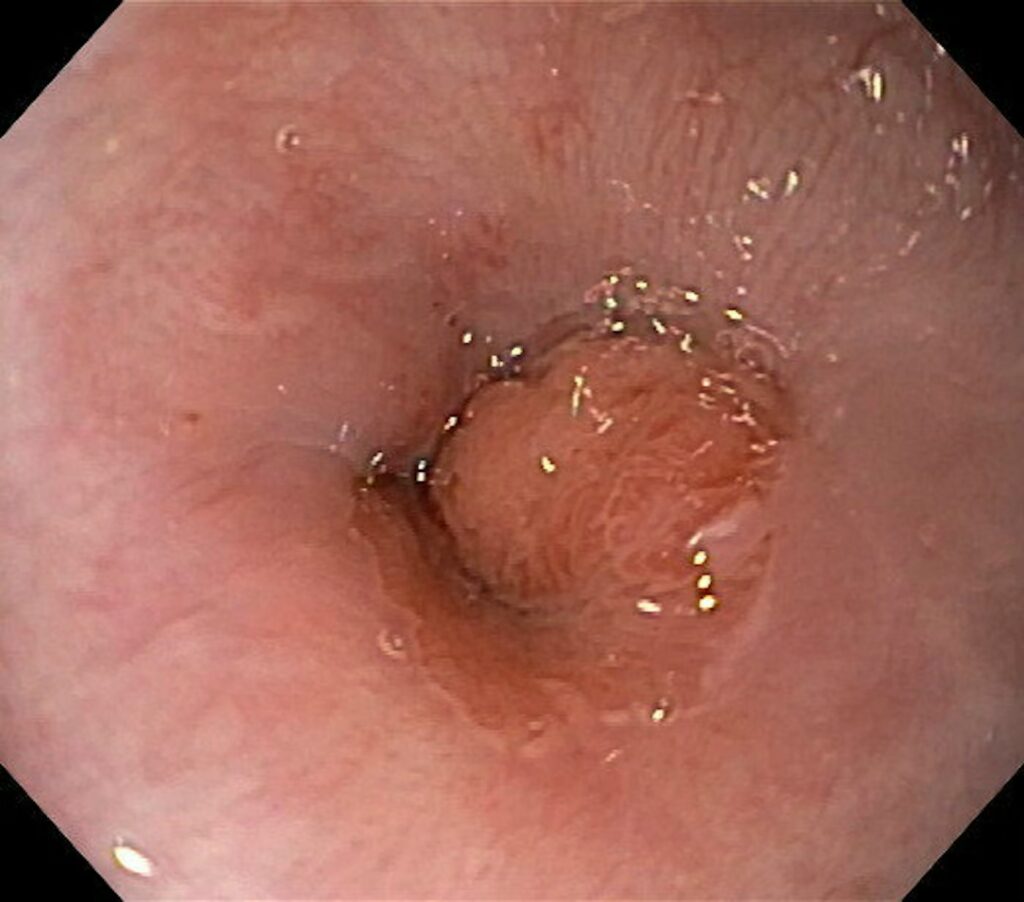 Adenocarcinoma Of The Cardia 13 Adenocarcinoma Of The Cardia