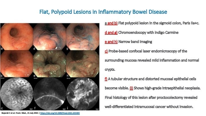 Advanced Endoscopic Imaging Techniques Improve Characterization Of Polypoid And Flat Polypoid Lesions In Inflammatory Bowel Disease