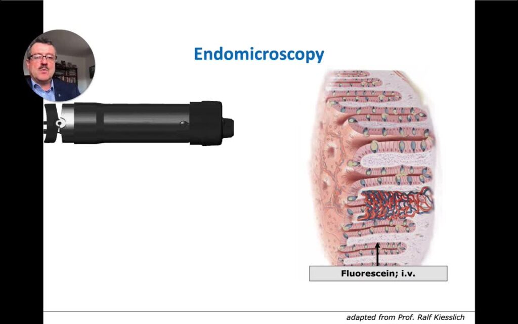 Advanced Endoscopic Imaging – The Quest For Virtual Histology
