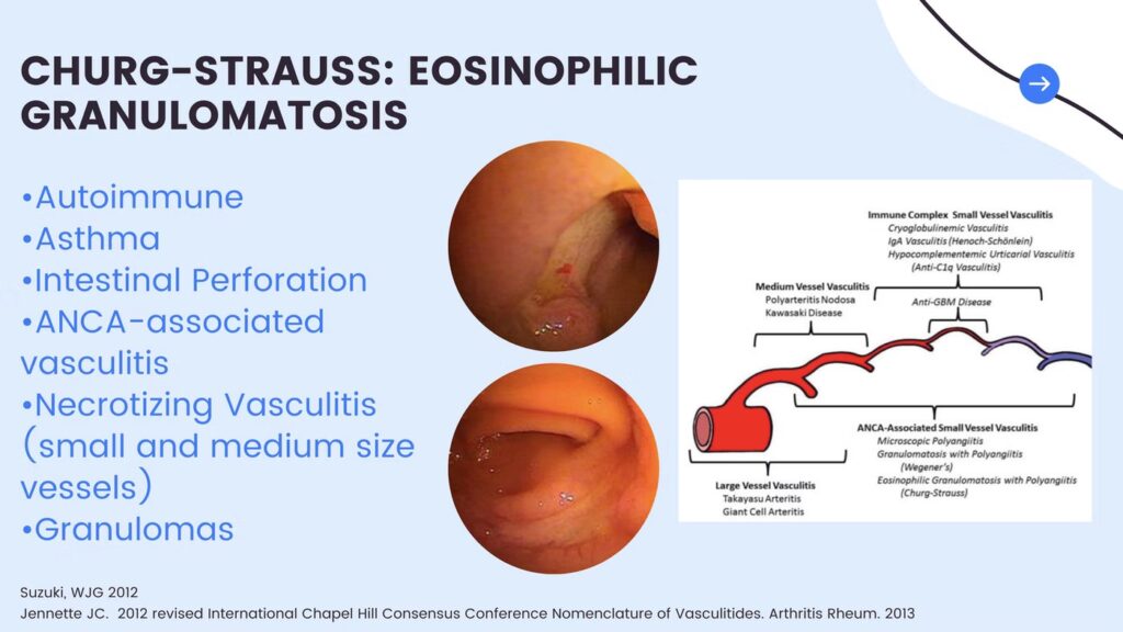 Allergic Granulomatosis With Polyangitis (Agpa) Or Churg-Strauss Vasculitis