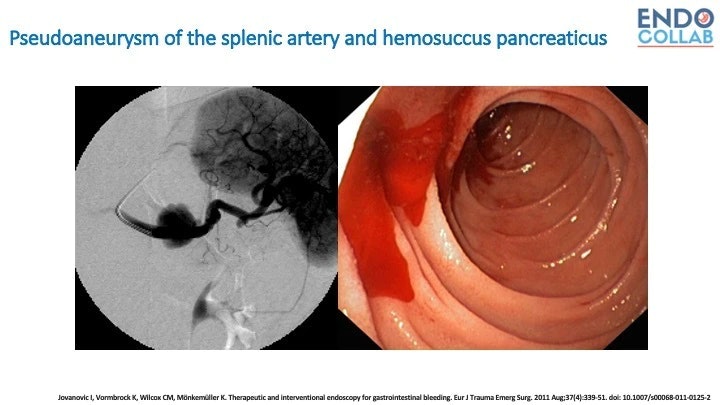 Always Think Of This Condition When Evaluating Gi Bleeding In Chronic Pancreatitis
