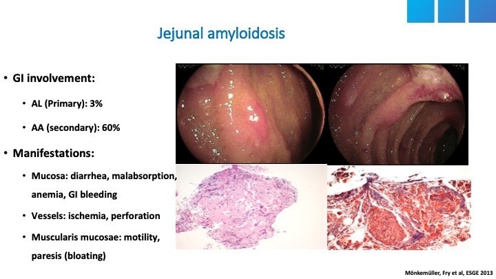 Amyloidosis Of The Small Bowel