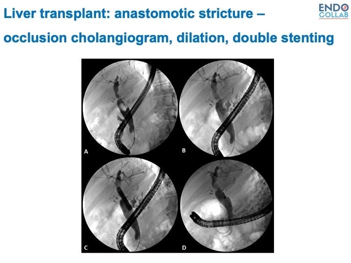 Anastomitc Stricture: Occlusion Cholangiogram, Dilation, Double Stenting