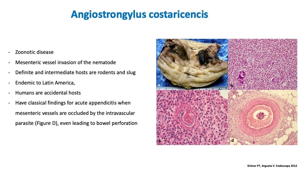 Angiostrongyloidiasis 17 Angiostrongyloidiasis