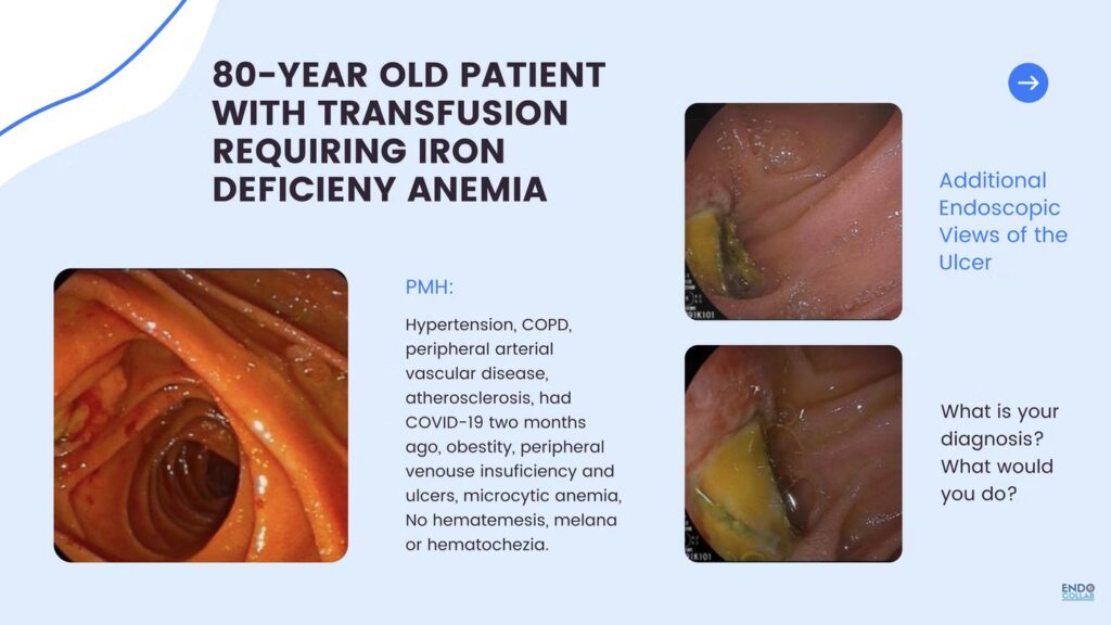 Aoroenteric Fistula From Stent Eroding From Aorta Into Distal Duodenum