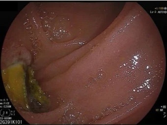 Aortoenteric Fistula (Two Examples – One Management Option)
