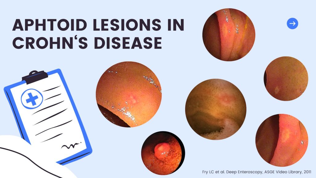 Aphtoid Lesions 13 Aphtoid Lesions