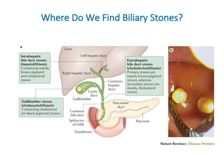 Approach To Bile Duct Stones 17 Approach To Bile Duct Stones