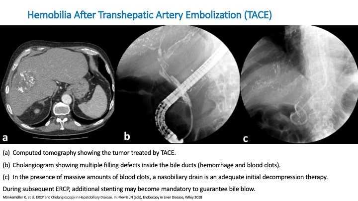 Atypical Bile Duct Filling Defects - Hemobilia After Transhepatic Arterial Chemoembolization (Tace). 15 Atypical Bile Duct Filling Defects – Hemobilia After Transhepatic Arterial Chemoembolization (Tace).