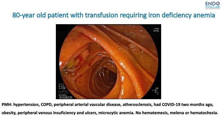 Atypical Duodenal Ulcer In Patients With Iron Deficiency Anemia